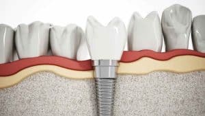 Why Bone Grafting Is Necessary When Getting Dental Implants