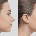 Affordable Rhinoplasty Worldwide Top Destinations to Get Your Nose Job