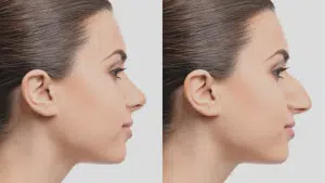 Affordable Rhinoplasty Worldwide Top Destinations to Get Your Nose Job