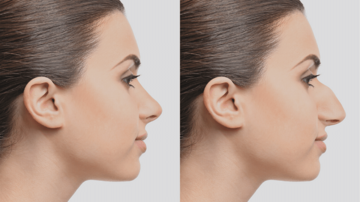 Affordable Rhinoplasty Worldwide Top Destinations to Get Your Nose Job