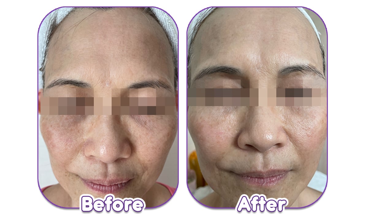 Improved Skin Texture And Tone Up With Belleera R15