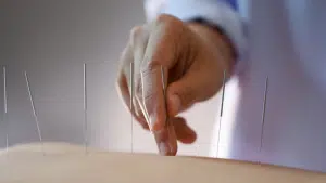 Is Dry Needling Legal in Nevada?