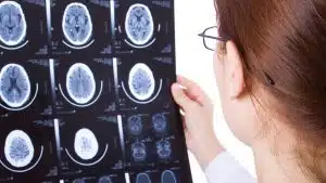 What Are The Legal Options After A Brain Stem Injury From A Car Crash?