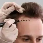 The Ultimate Guide to Hair Transplant Procedures, Benefits, and Considerations