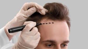 The Ultimate Guide to Hair Transplant Procedures, Benefits, and Considerations